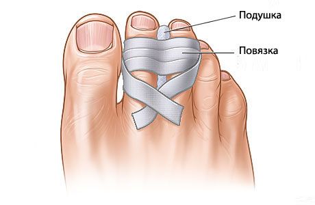 ما هي احتمالات استعادة أصابع القدم المكسورة؟