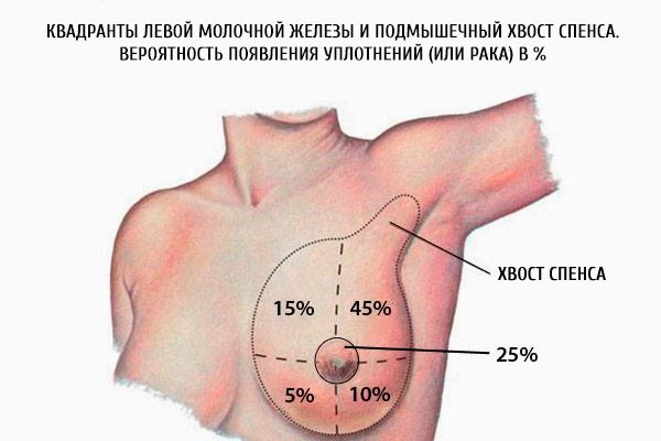 الأرباع من الثدي الأيسر والإبطاح سبن من سبينس.  احتمالية الاختام (أو السرطان) في٪