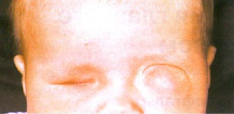Microphthalmus مع تكوين الكيس المصاحب (العين اليسرى).  Anophthalmus (العين اليمنى).