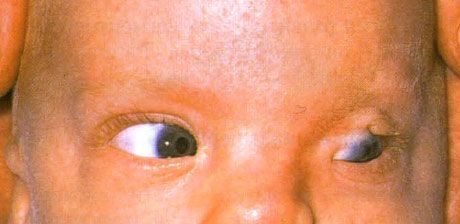 متلازمة فريزر.  cryptophthalmos غير مكتمل من العين اليسرى.