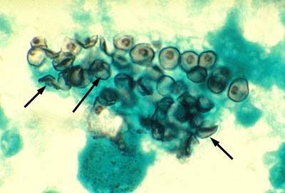 العامل المسبب للمكيسة الرئوية (Pneumocystis jiroveci)