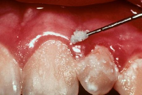 الأسنان والتهاب اللثة