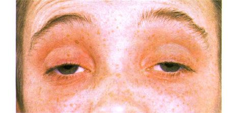 شلل العين الخارجي.  تدلي الجفون على الوجهين.  يفتح المريض عينيه عن طريق رفع حاجبيه