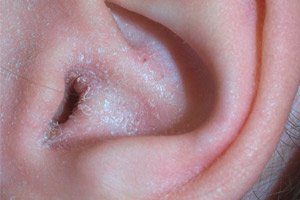استعادة مائة واد  قشرة الأذن: الأسباب والعلاج
