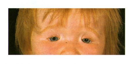 ورم أرومي لجانبين في الطفل مع متلازمة غولدن.  إغلاق فتحة العين على اليسار